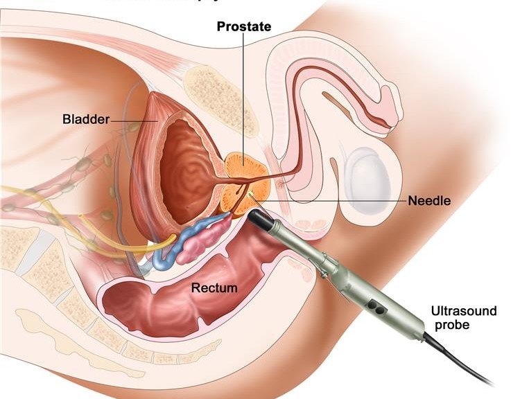 What you Need to Know About Prostate biopsy