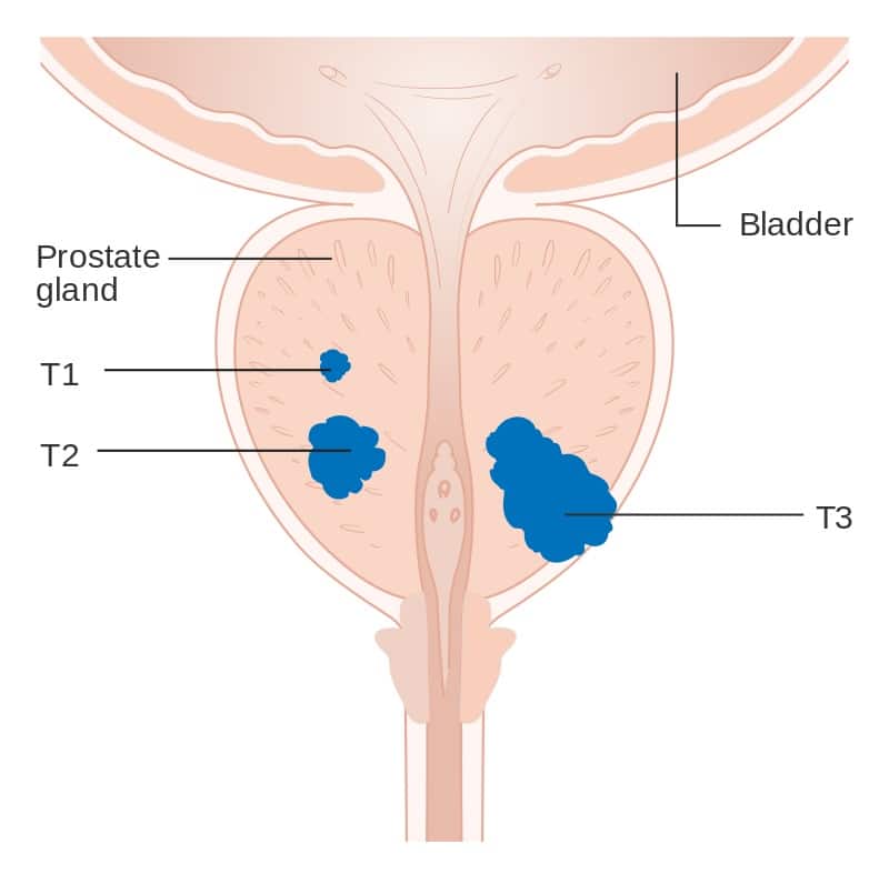 When prostate cancer spreads, it most often spreads to the bone.
